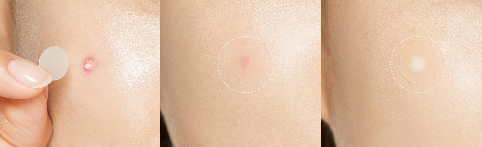 ACNE Pimple Master Patch